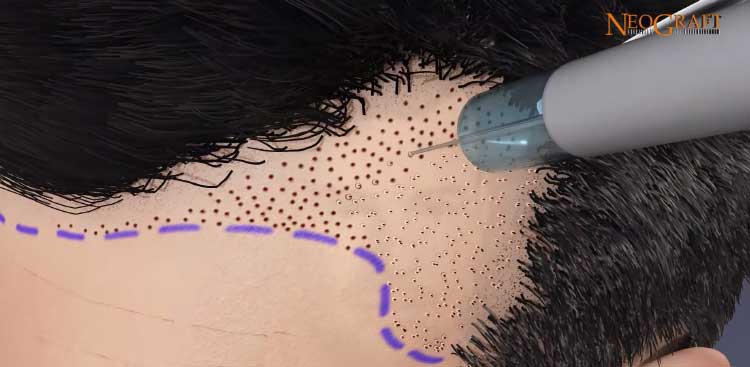 taxe e-liquide france L'impact du Tabagisme sur le succès de la Greffe de cheveux Considérations  essentielles main image 0