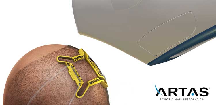 Greffe de cheveux IFA (robot ARTAS) : prix, fonctionnement et rsultats