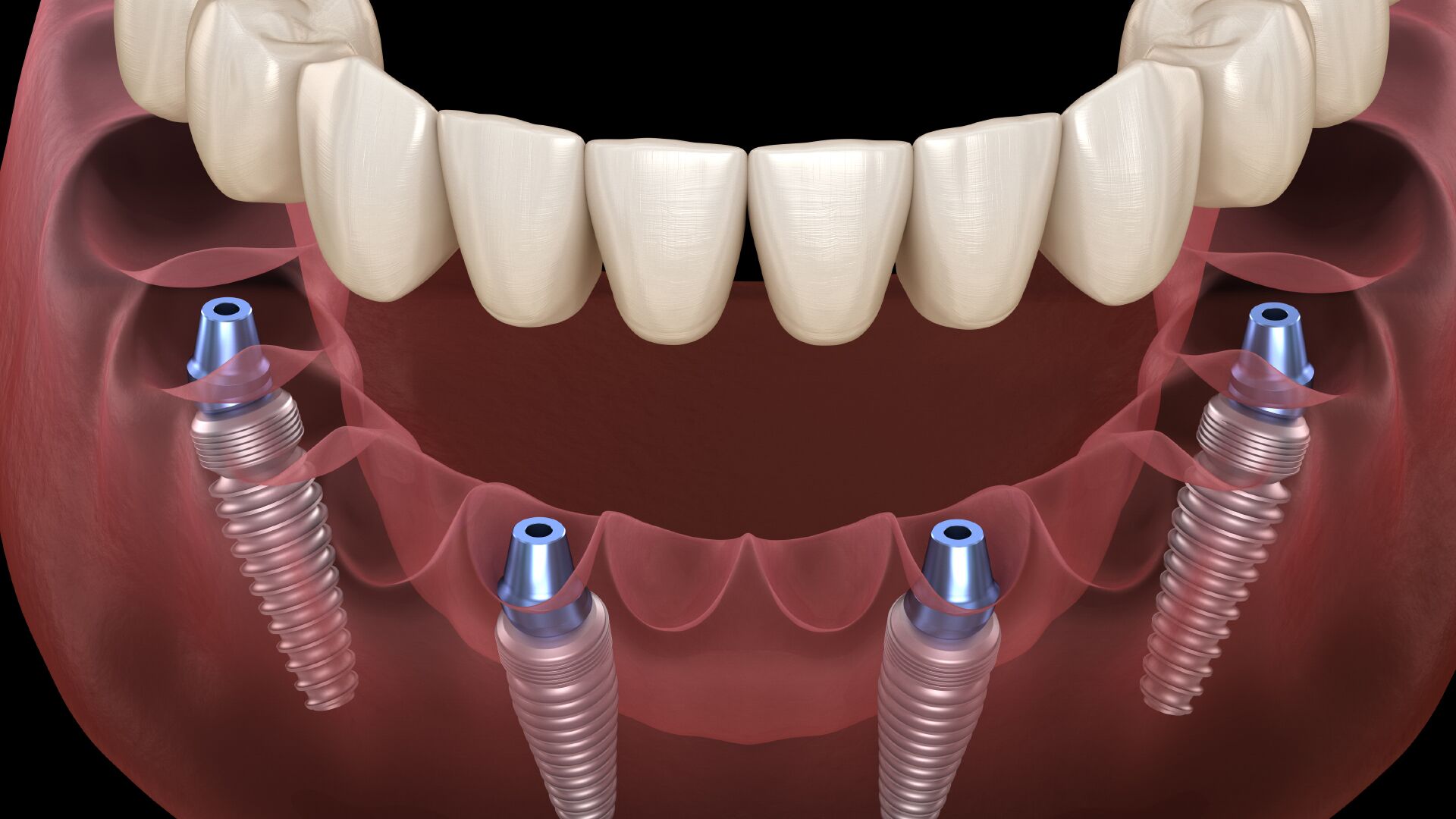 elfbar nachfüll pod läuft aus Guide complet de l'Implant dentaire : Pose, Prix et Conseils