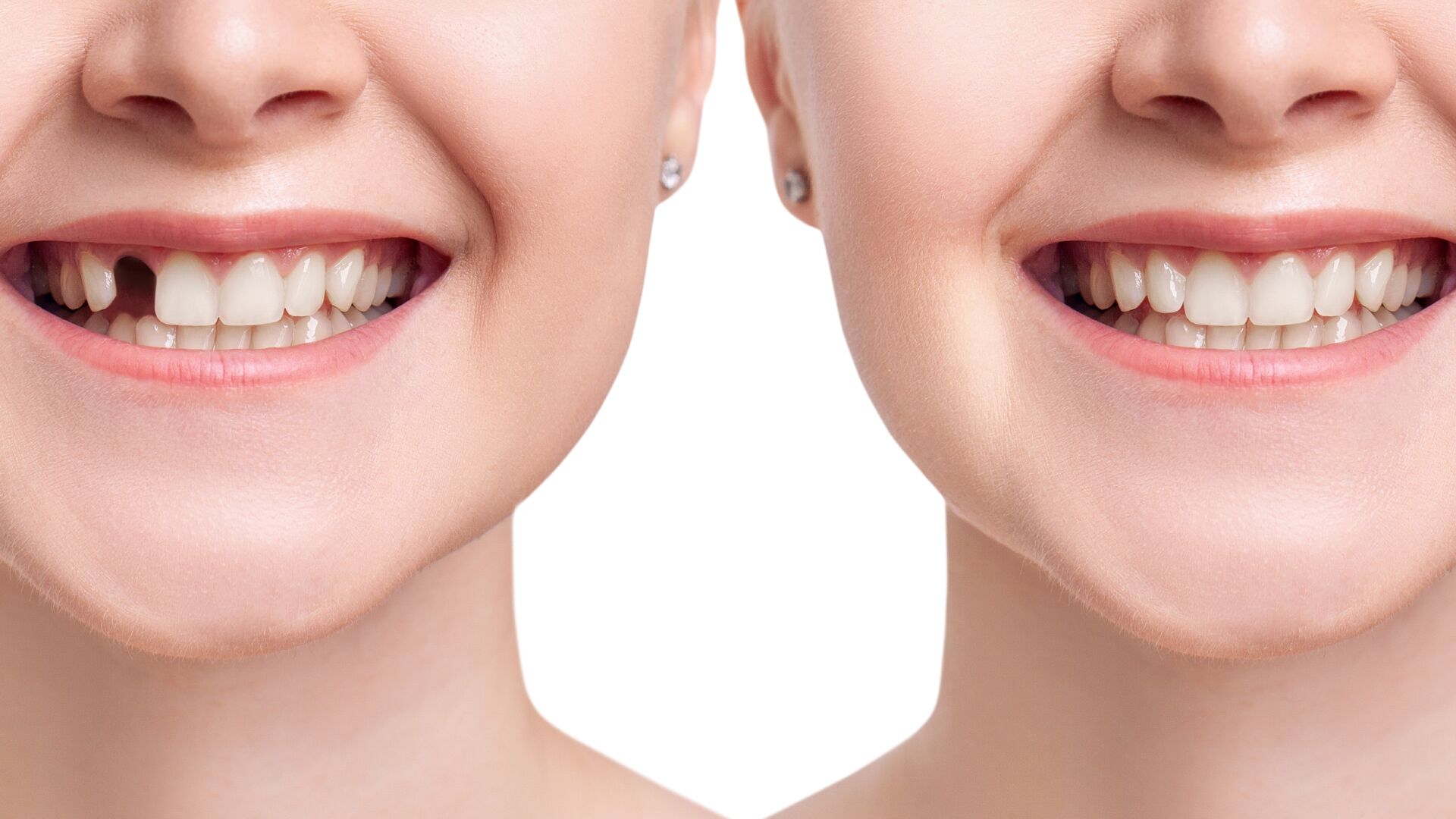 elfbar nachfüll pod läuft aus Vapoteuse & Santé buccale? - Dentiste Sainte-Thérèse main image 1