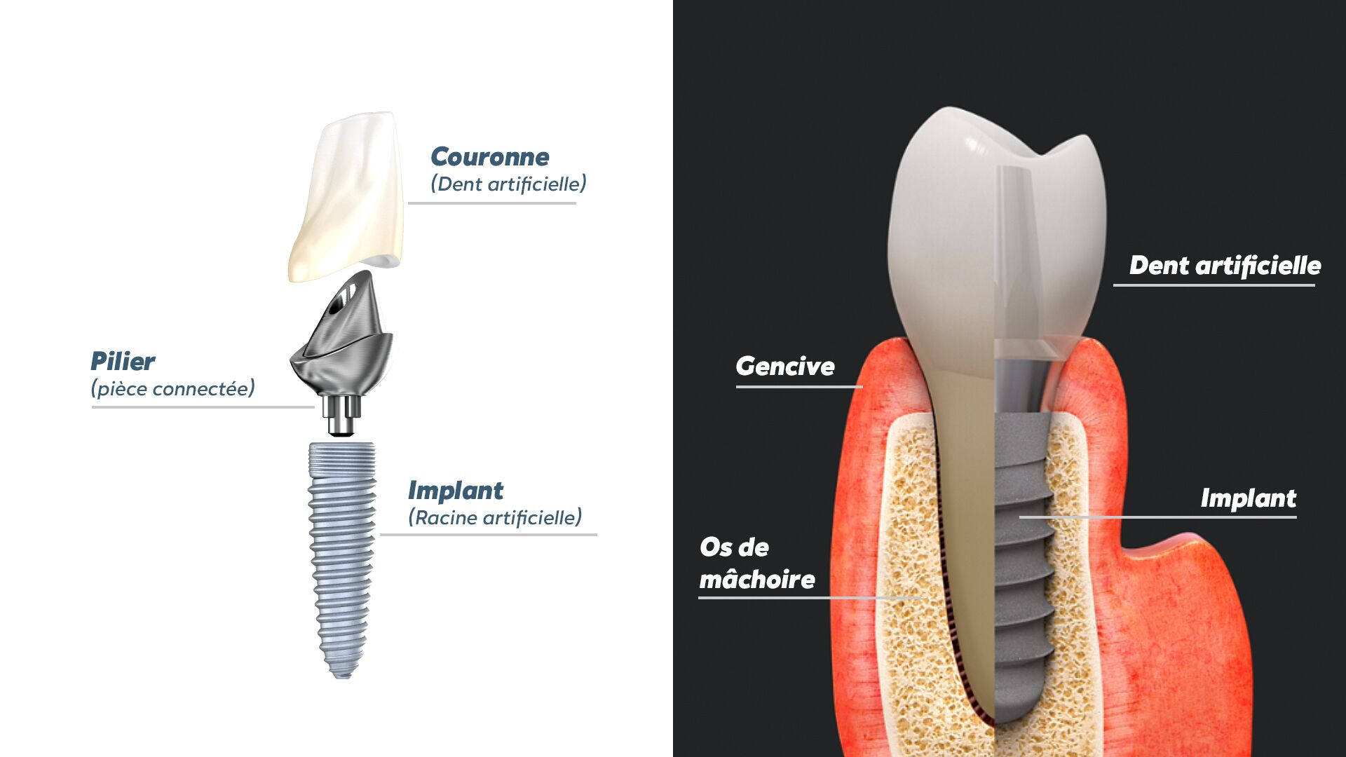 Implant dentaire risques : quels sont le risques et complications possibles  ?