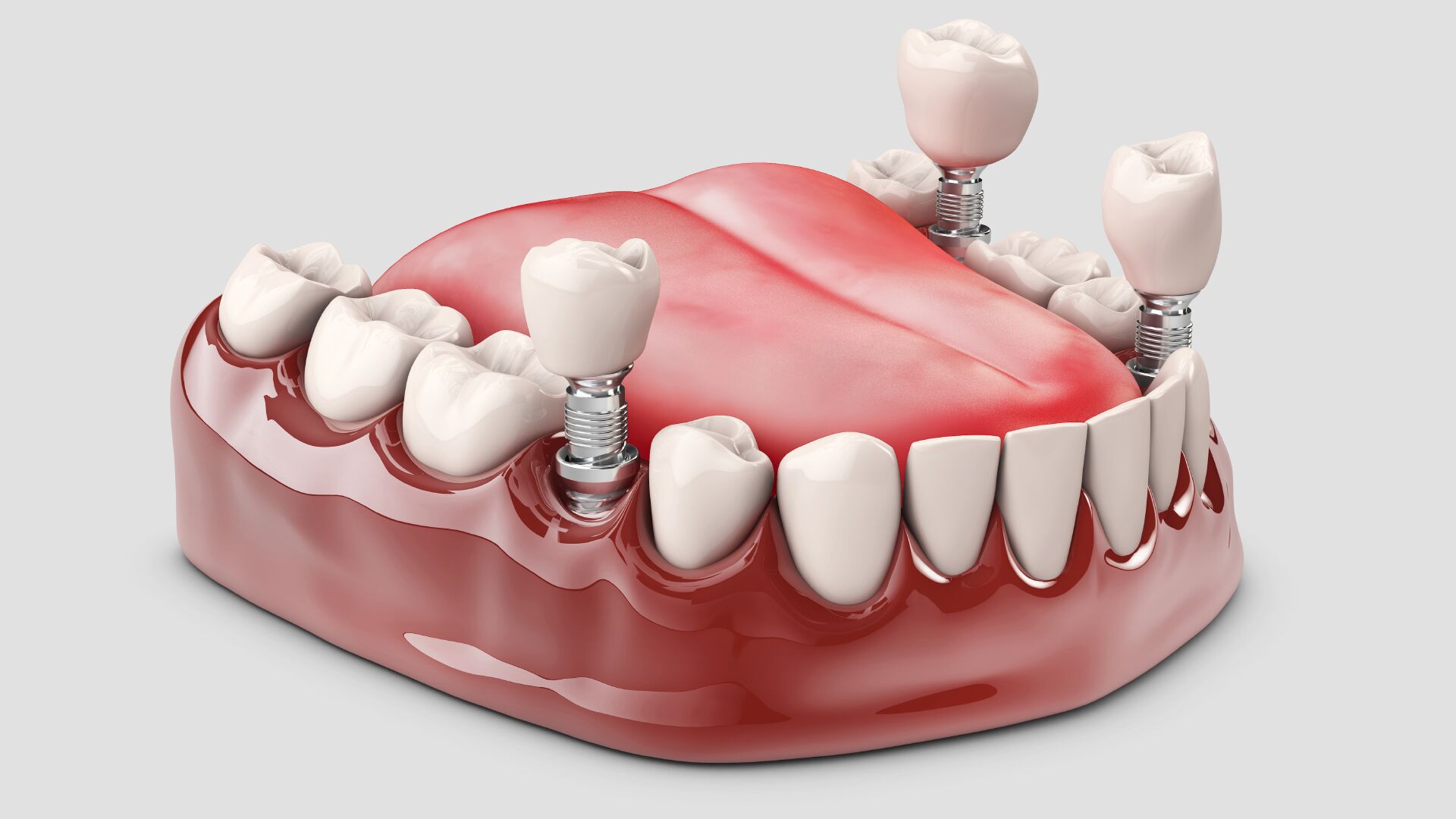 Implant dentaire risques : quels sont le risques et complications possibles  ?