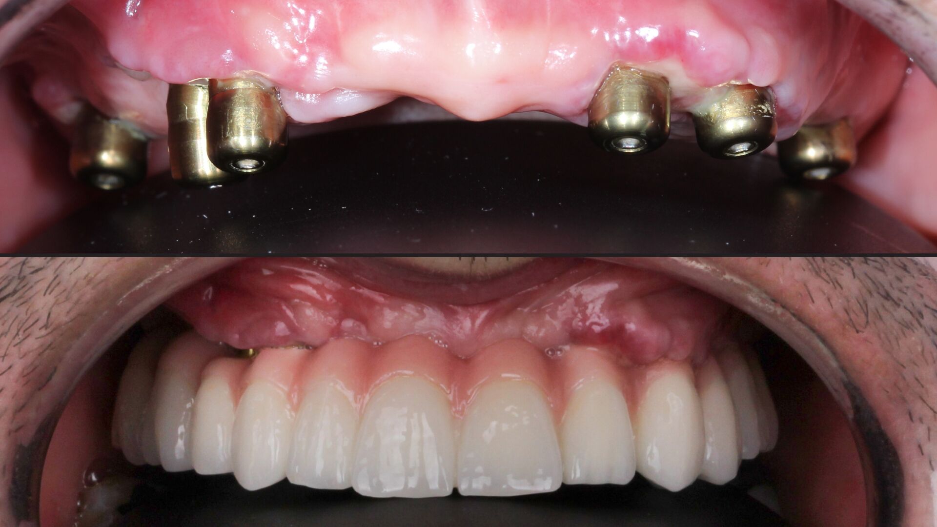 Implant dentaire risques : quels sont le risques et complications possibles  ? | Body Expert